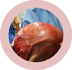 REMOVED BIG TUMOUR